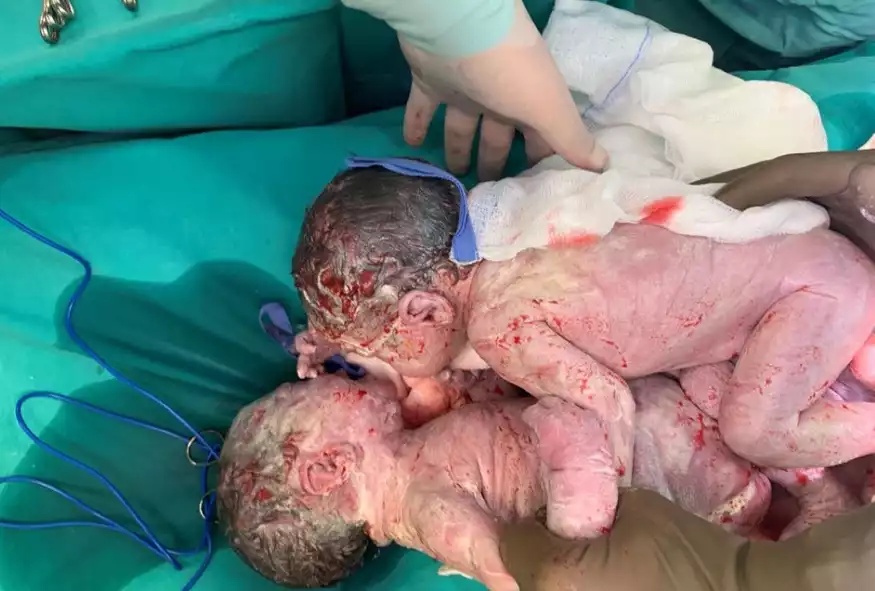 Θαύμα ζωής στη Θεσσαλονίκη: Νίκησε τον καρκίνο στα γεννητικά όργανα και απέκτησε δίδυμα με τη βοήθεια φίλης της που έγινε παρένθετη